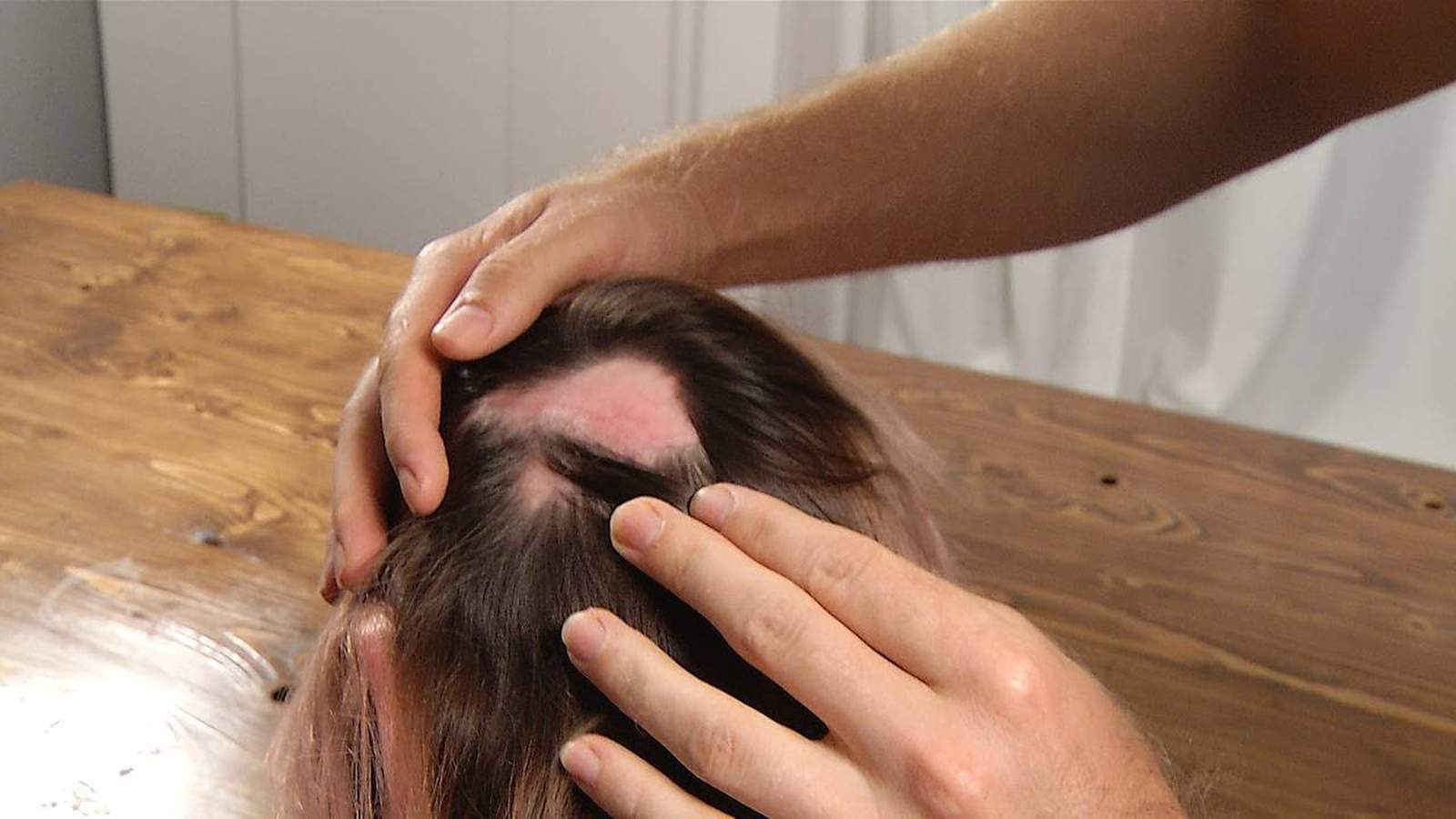 Woman Warns Of Salon Dangers After Sustaining Chemical Burns